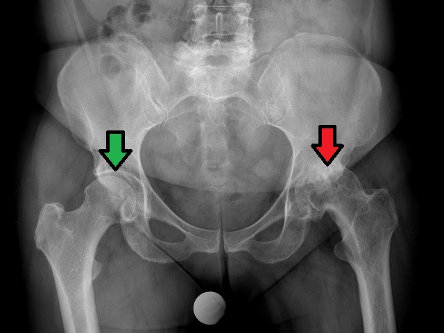 normal male hip arthritis xray